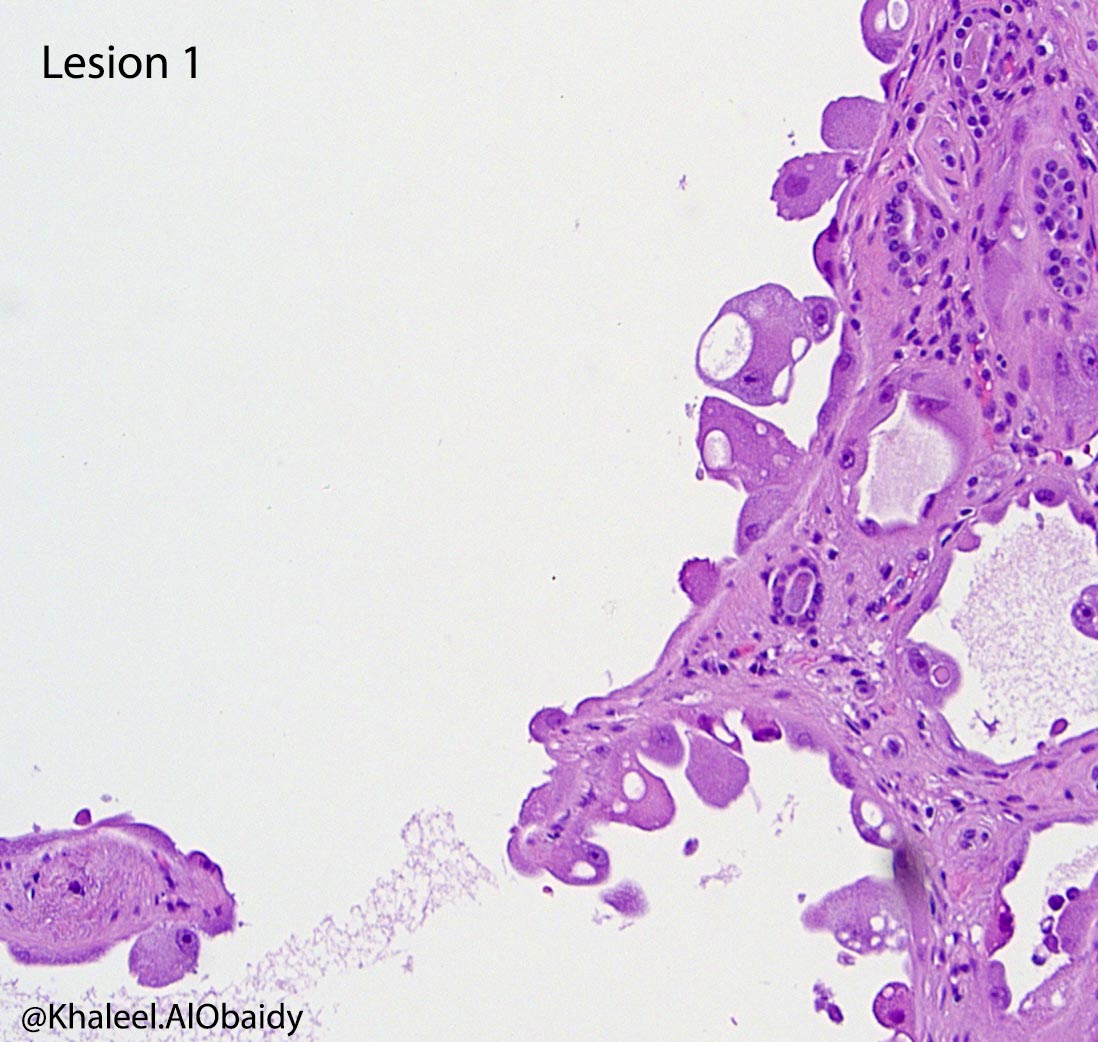 KhaleelAlObaidy's tweet photo. That's why I love kidney #gupath. 32 different lesions/tumors in one case. Bilateral nephrectomy for ESRD. Only few here :D  @slusagar @Williamson_SR @AkgulMd @MJMagersMD @LiangChengMD @Kiril_T_Can https://t.co/vdYWR1vilH