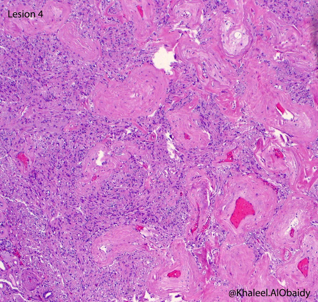KhaleelAlObaidy's tweet photo. That's why I love kidney #gupath. 32 different lesions/tumors in one case. Bilateral nephrectomy for ESRD. Only few here :D  @slusagar @Williamson_SR @AkgulMd @MJMagersMD @LiangChengMD @Kiril_T_Can https://t.co/vdYWR1vilH