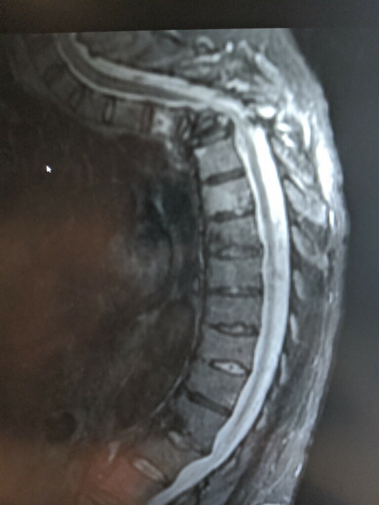 dougbeall's tweet photo. The Dr caring for this patient didn’t “believe” in kyphoplasty. The follow-up MRI (on the right)makes me wonder if they believed in #paralysis or #severedisability or #mortality. #vertebralaugmentation has been shown to be life prolonging (NNT = 15) @RachelleBuchbin @ASBMR https://t.co/u013VA3PH7