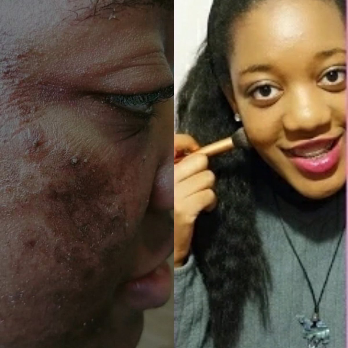 Every parent that has a child who is going through eczema flares will understand the pain and frustration your child goes through every episode of battling against infectiom until Dermazeam 😊 see what people are saying. #eczema #eczemababy #eczemaremedy shop.carolsorganickitchen.com/product/dermaz…