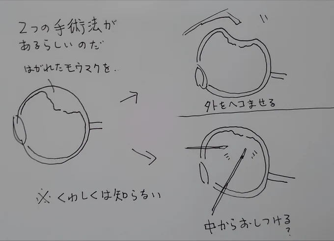 昨日は久しぶりの休みだったので、一日中寝ていたけれど、あまり良くなった感じがない。このままだと、別のやりかたで再手術らしいので、一回の網膜剥離で2つの手術を体験するお得体験コースになってしまう。
(お金は2回分払うから、お得じゃないという話もある) 