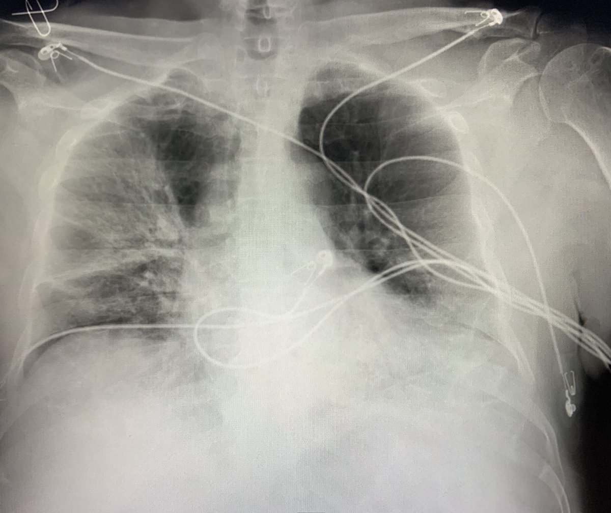 alemoyaal's tweet photo. Si por casualidad escucha más sirenas en la calle es porque el número de pacientes graves con #covid19 va en aumento y si ... efectivamente hay más ambulancias trasladando pacientes y se van a morir muchos más  #QuedateEnCasa https://t.co/w81JH7LseU