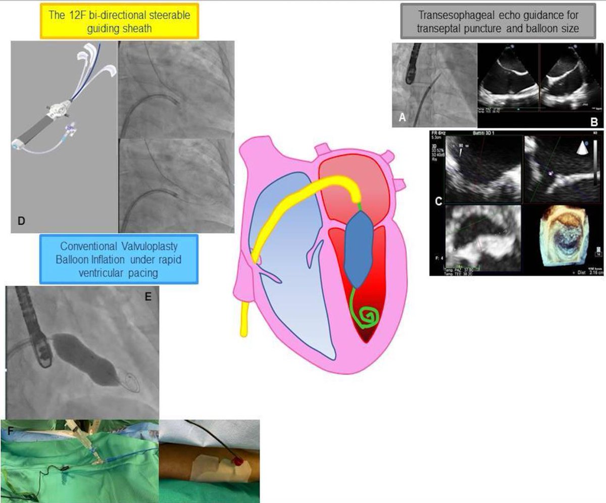 EuroInterventio's tweet photo. "A Novel Technique For Percutaneous Mitral Balloon Valvuloplasty" by Cristina Aurigemma @BURZOTTA_F et al. #EAPCI
https://t.co/2xvY1gGlS4 https://t.co/CVOM8My5TL