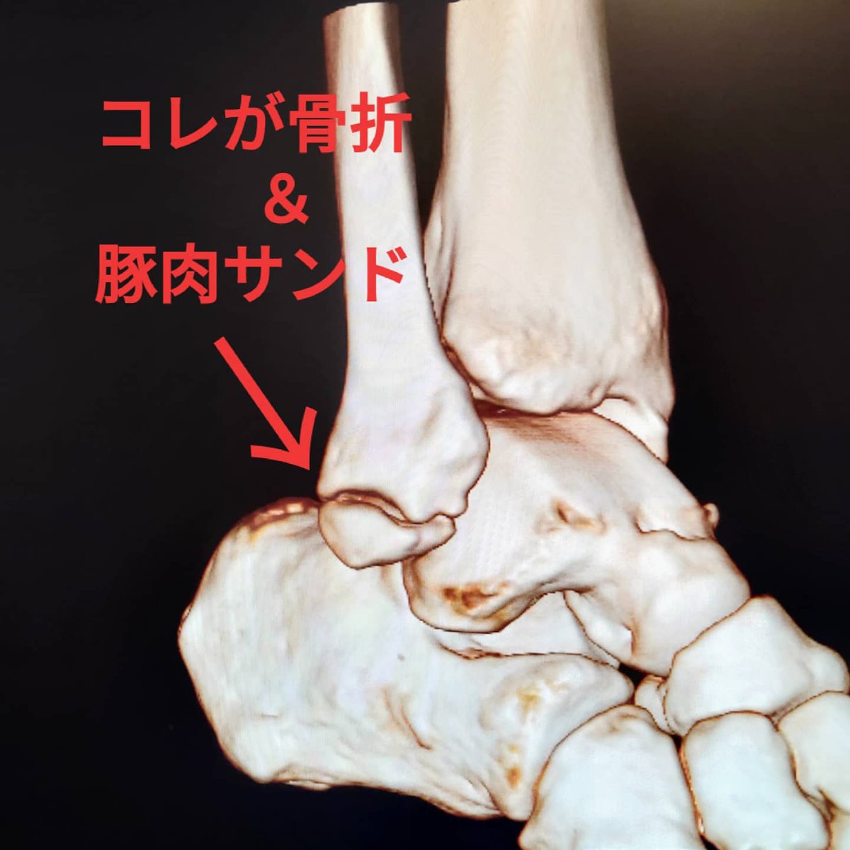 ট ইট র ぶででぶブーブー こちらが手術前の足首ct画像 初め見せられた時 ココは元から小さい骨がある構造なのかと思ったら 折れてますよ 骨と骨の間に肉入ってます と これでフツーに４ヶ月過ごしてたとは 我ながら驚く 骨折 偽関節 Ct画像 無事