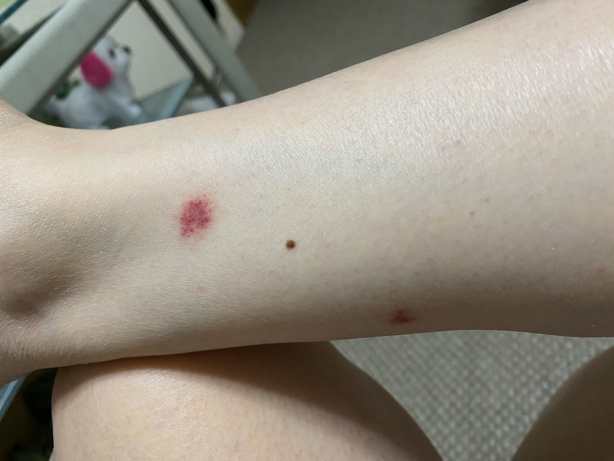 マダニ 噛ま れ た 跡 マダニに刺された跡の画像と体験談 病院は何科 取り方は マダニ 噛ま れ た 跡 マダニに刺された跡の画像と体験談 病院は何科 取り方は