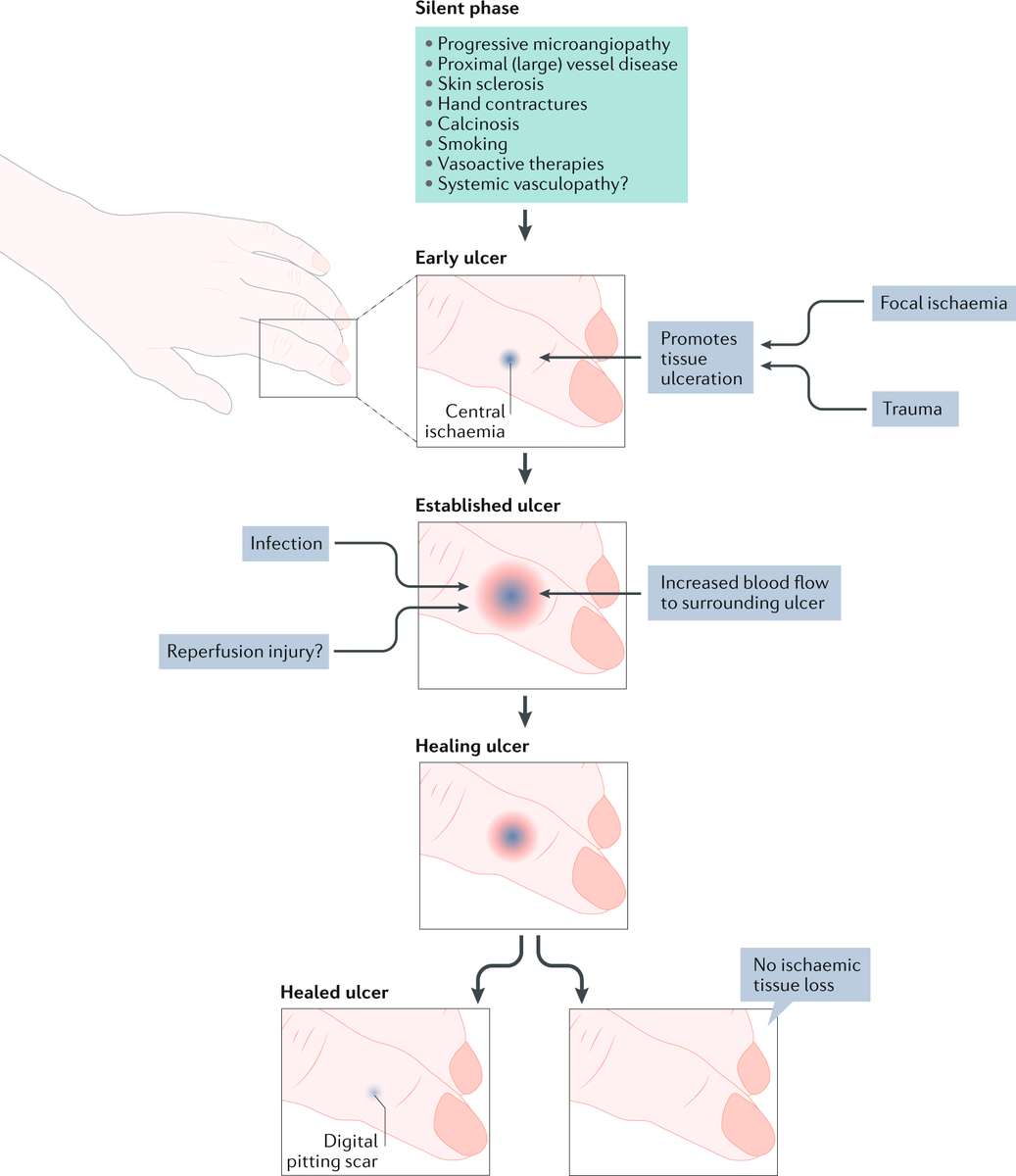 NatRevRheumatol's tweet photo. Our #Review on Raynaud phenomenon and digital ulcers in systemic sclerosis is currently #free to access as part of our #collection on #SystemicSclerosis. Check it out while you can!
#Raynauds #ulcers #Scleroderma #Therapy #Vascular #wsc20
https://t.co/7Epvgq6WY4 https://t.co/yndiajzGz0