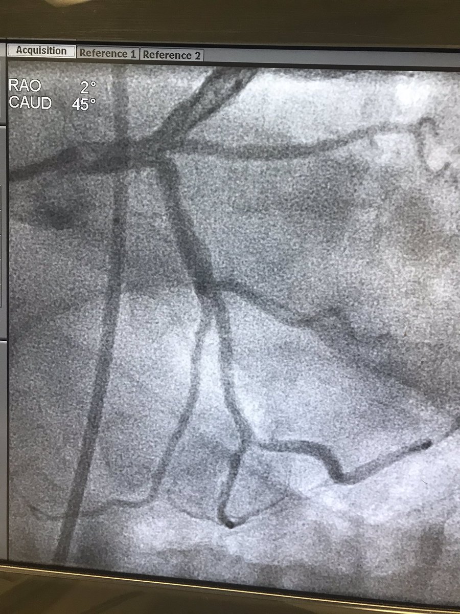 WilliamWuHVC's tweet photo. 36 year old Latin American man suffered from non stemi. He was found To have chronic total occlusion of proximal rca and om two . I was requested to perform pci to om branch and RCA. https://t.co/bmKTudCiI0