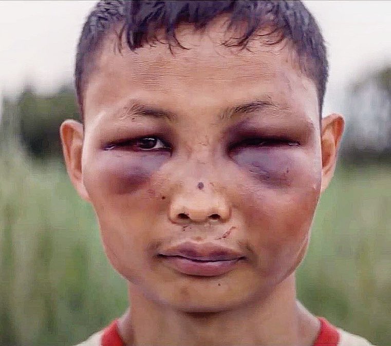 LethweiWorld's tweet photo. 15 years old fighter one week after a #Lethwei war💪🏽 No Ice, no doctors, just balls of steel.
Featured in Frank Grillo’s Docu-series #Fightworld on #Netflix. https://t.co/QC6gc0YH1m