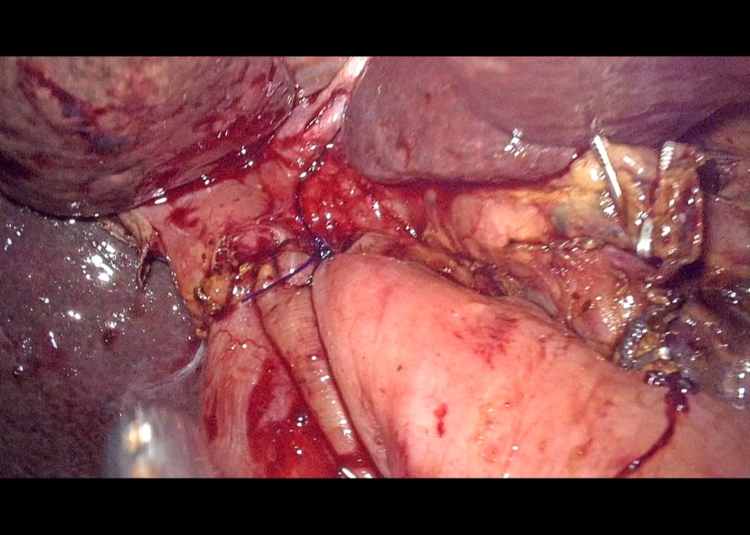 dr_srik's tweet photo. Amidst COVID a wonderful achievement from Dr. Srikant Patro, SRUSTI HOSPITAL, CUTTACK, ODISHA.

TOTAL LAPAROSCOPIC PANCREATICO-DUODENECTOMY.
Being the most complex abdominal operation it is First of its kind in Eastern part of India. #IHPBA #HFWOdisha https://t.co/oH9QsWi26d