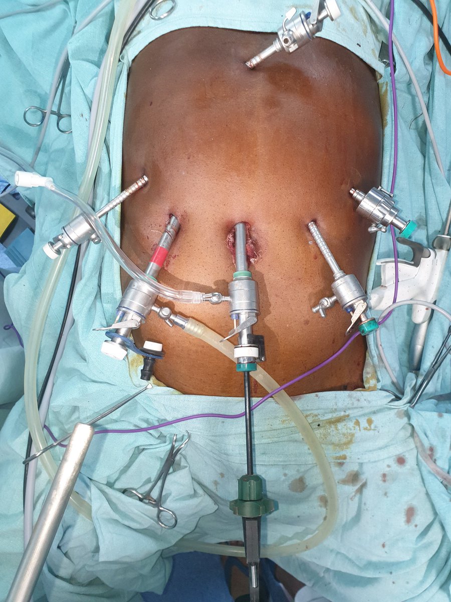 dr_srik's tweet photo. Amidst COVID a wonderful achievement from Dr. Srikant Patro, SRUSTI HOSPITAL, CUTTACK, ODISHA.

TOTAL LAPAROSCOPIC PANCREATICO-DUODENECTOMY.
Being the most complex abdominal operation it is First of its kind in Eastern part of India. #IHPBA #HFWOdisha https://t.co/oH9QsWi26d