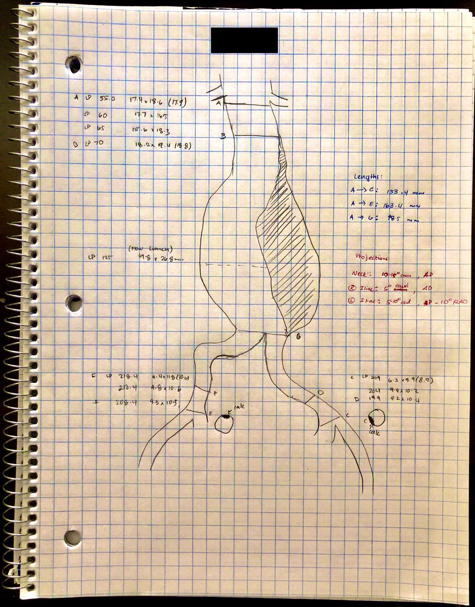 Favorite part of aortic endovascular repair is the planning phase! Feels like vascular architecture and legos! <a href="/VISLAMDSCAIP/">GVATAKEN</a>  <a href="/quienlam/">Ken Lam</a> <a href="/ABhattMD/">Alok Bhatt</a> @hd0890 <a href="/JemIR_MD/">Jemianne Bautista Jia, MD</a> <a href="/ZaeemBillah/">Zaeem Billah</a> <a href="/SIRRFS/">SIR RFS</a> #aaa #evar