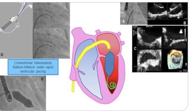 BURZOTTA_F's tweet photo. Not happy with Inoue #PTMV ?? Just published in @EuroInterventio: our NEW DIRECTIONAL TECHNIQUE for percutaneous #mitralvalve balloon #valvuloplasty. Enjoy the beauty of using a similar approach for all #heartvalves dilation. Great #teamwork in our #cath lab! #structuralheart https://t.co/fkh9j4bWir