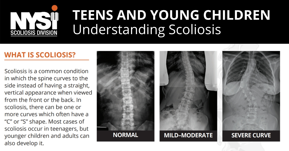 NYSPINEINST's tweet photo. Scoliosis is a spine condition often found in adolescents. The Scoliosis specialists at #NYSpine have years of experience and a unique perspective in evaluating and treating all different types of scoliosis and spine conditions. Learn more: https://t.co/XZinHTIMSh https://t.co/PIVI9lYAQt