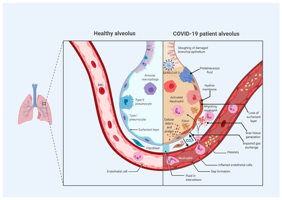 TropicalmedMDPI's tweet photo. #TropicalmedMDPI Faryal Farooqi et al. @LARKINHOSPITAL, @TrinityMedNews Treatment of Severe #COVID-#19 with #Tocilizumab Mitigates #Cytokine #Storm and Averts Mechanical Ventilation during Acute Respiratory Distress: A Case Report and Literature Review 
https://t.co/VIkuOyWaoi https://t.co/nc6mHb5Ar7