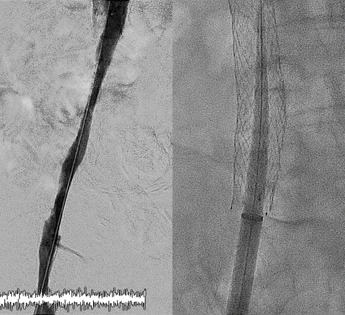 tan_guangming's tweet photo. we performed ad hoc progressive venoplasty, 6, 10 then 12 mm balloon. successfully passed 27fr sheath. no perforation. will you stent to finish?
#venoplasty #endofirst https://t.co/NCoqLxrxlf
