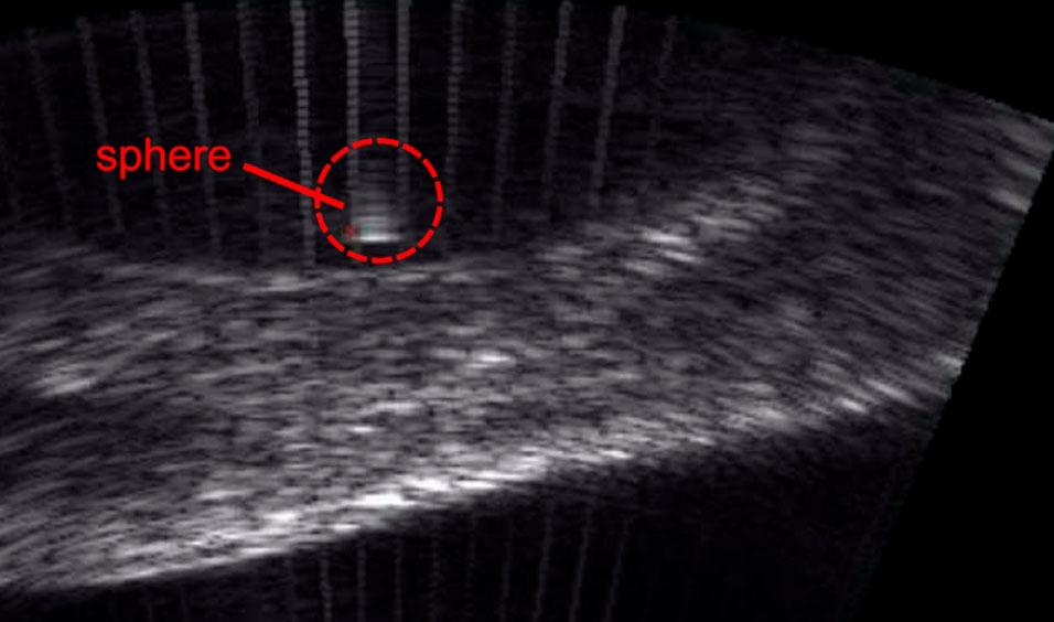 Researchnewscc's tweet image. &apos;Acoustic tweezers&apos; may offer noninvasive solution to kidney stones and other medical applications ow.ly/DH6O50AwfF2 #Acoustictweezers #noninvasivesolution #kidneystones #medicalapplications #science #newspaper