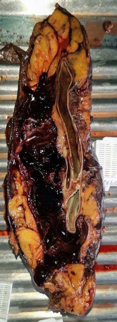 HugoLeonUrology's tweet photo. Today:
Man 32 y.o. previously history: none
Acute flank pain plus decreased hemoglobin from 12gr/dl to 8 gr/ dl and unstable hemodynamically 
Blood transfusion 4 units
Performance: Nephrectomy.
@AS7UroAlexis @drMontenegro88 @Ricardouromed @wilsonpereyrav https://t.co/31auCAJgkc