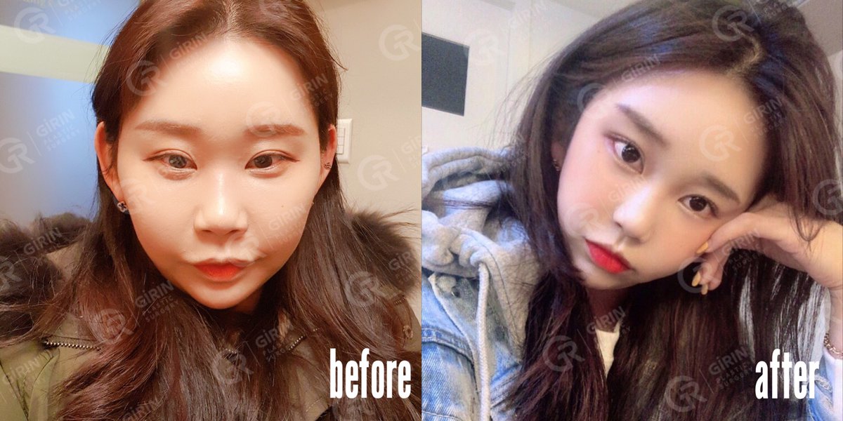 韓国girin美容整形外科 Sur Twitter Girin 頬骨縮小術 目尻切開 で コンプレックス改善 可愛さ2倍アップ した彼女の詳しいdtが気になる方は 今すぐチェック T Co 11l8rnaul1 ラインhttps T Co Xtxausyf4q タレ目形成 グラマラスライン 韓国girin美容整形外科 Sur Twitter Girin 頬骨縮小術 目尻切開 で コンプレックス改善 可愛さ2倍アップ した彼女の詳しいdtが気になる方は 今すぐチェック T Co 11l8rnaul1 ラインhttps T Co Xtxausyf4q タレ目形成 グラマラスライン