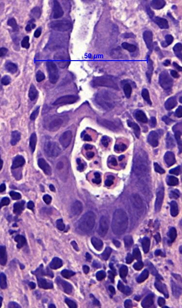 Here we go with my first tweeted case! Middle aged patient, on treatment for lung adenocarcinoma.