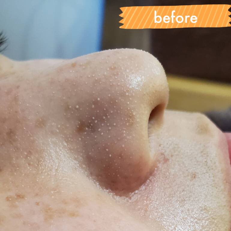 Bulan お鼻の毛穴集中フェイシャル 小鼻の黒ずみ 白いポツポツ 汚れなど 特殊マスクと超音波洗浄で大掃除していきます その後 汚れを詰りにくくするための引き締めマスクをしていきます ごっそり汚れを除去してツルツルなお鼻になれますので お悩み Bulan お鼻の毛穴集中フェイシャル 小鼻の黒ずみ 白いポツポツ 汚れなど 特殊マスクと超音波洗浄で大掃除していきます その後 汚れを詰りにくくするための引き締めマスクをしていきます ごっそり汚れを除去してツルツルなお鼻になれますので お悩み