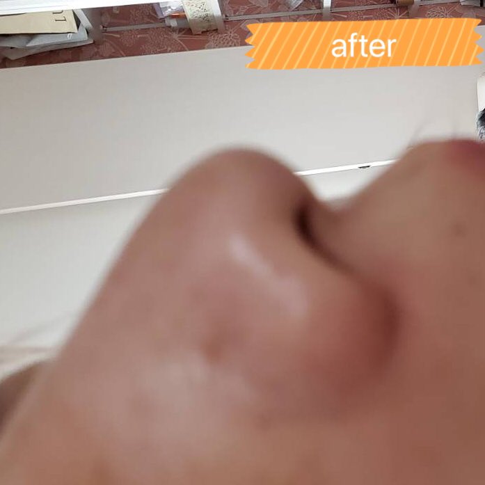 Bulan お鼻の毛穴集中フェイシャル 小鼻の黒ずみ 白いポツポツ 汚れなど 特殊マスクと超音波洗浄で大掃除していきます その後 汚れを詰りにくくするための引き締めマスクをしていきます ごっそり汚れを除去してツルツルなお鼻になれますので お悩み Bulan お鼻の毛穴集中フェイシャル 小鼻の黒ずみ 白いポツポツ 汚れなど 特殊マスクと超音波洗浄で大掃除していきます その後 汚れを詰りにくくするための引き締めマスクをしていきます ごっそり汚れを除去してツルツルなお鼻になれますので お悩み