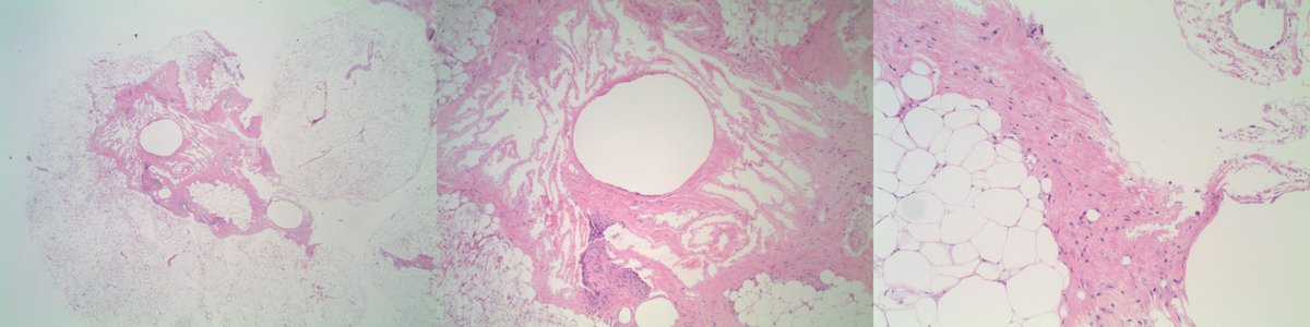 slusagar's tweet photo. esp for the #pathnewbies who might have not heard this term before in #breastpath:
"membranous fat necrosis" (basically cystic/fibrillar pattern fat necrosis)
with calcs in this case (core bx done for calcs, so rads/path๐๐ฝcorrelation) https://t.co/t3I6X3YHIr