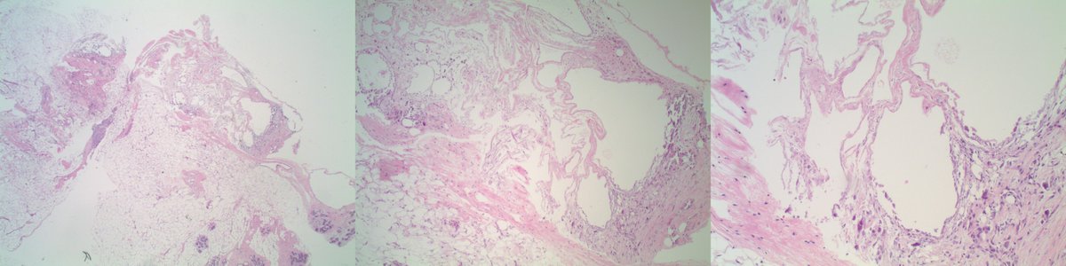 slusagar's tweet photo. esp for the #pathnewbies who might have not heard this term before in #breastpath:
"membranous fat necrosis" (basically cystic/fibrillar pattern fat necrosis)
with calcs in this case (core bx done for calcs, so rads/path๐๐ฝcorrelation) https://t.co/t3I6X3YHIr