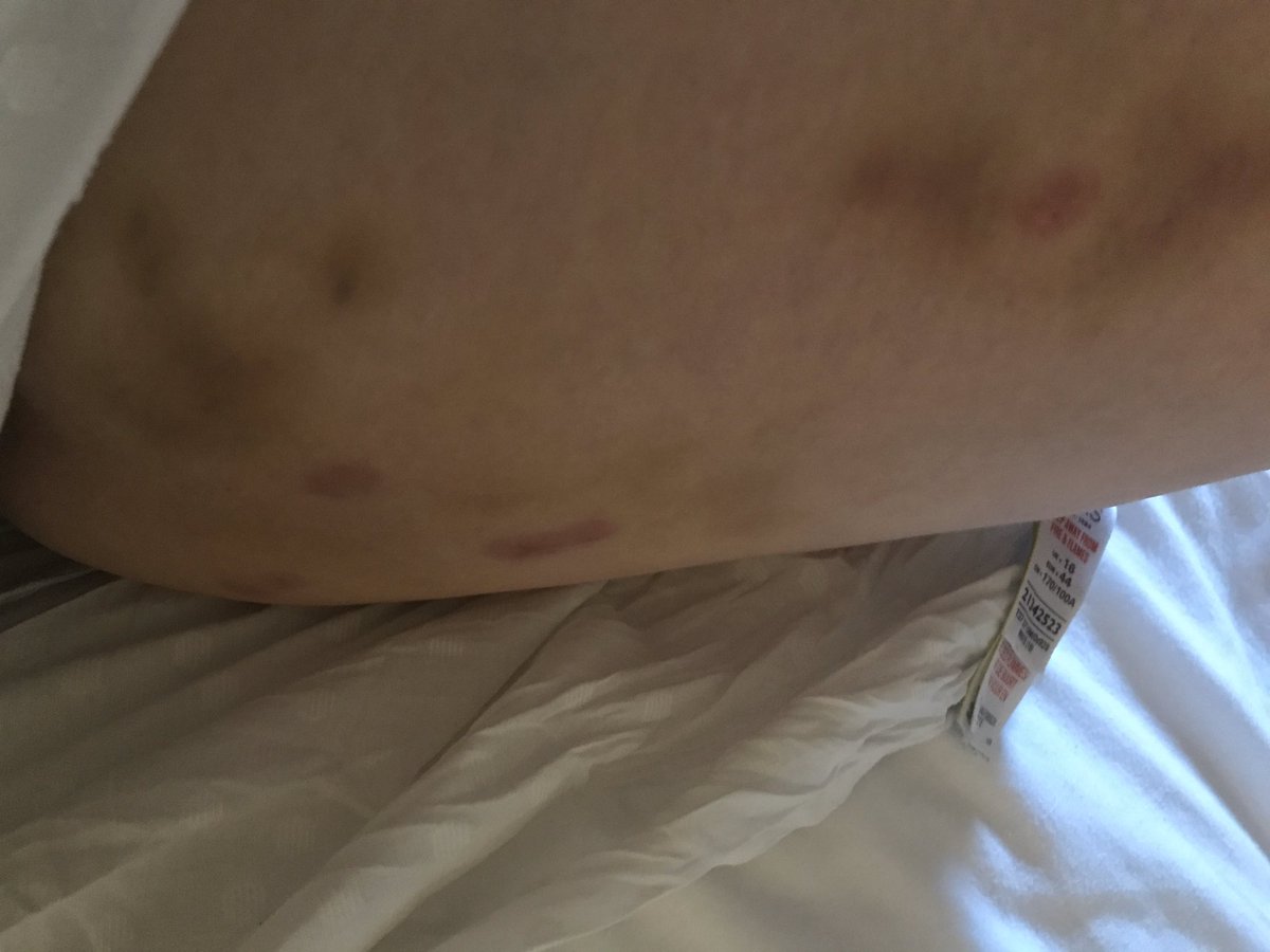 UKstrolling's tweet photo. @UKLyme we’ve been asked for help on this bite pattern. Does your community have any ideas? https://t.co/rLBuMqEazS