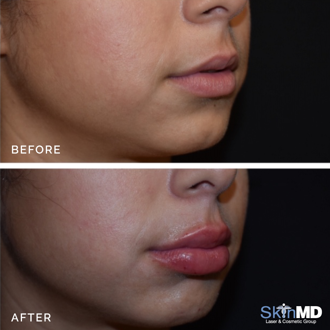 skinmdBOS's tweet photo. These lips are simply AMAZING! 💋😍First time patient who showed Dr. Shanley exactly what she wanted. All done using Restylane L!

#beforeandafter #lipinjection #skinmd #medspa #liptreatment https://t.co/Ct4A9LZGHf