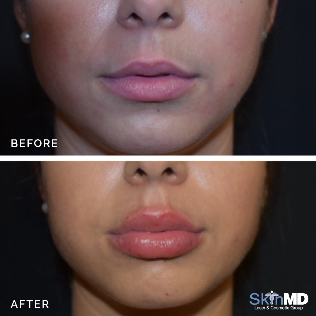 skinmdBOS's tweet photo. These lips are simply AMAZING! 💋😍First time patient who showed Dr. Shanley exactly what she wanted. All done using Restylane L!

#beforeandafter #lipinjection #skinmd #medspa #liptreatment https://t.co/Ct4A9LZGHf