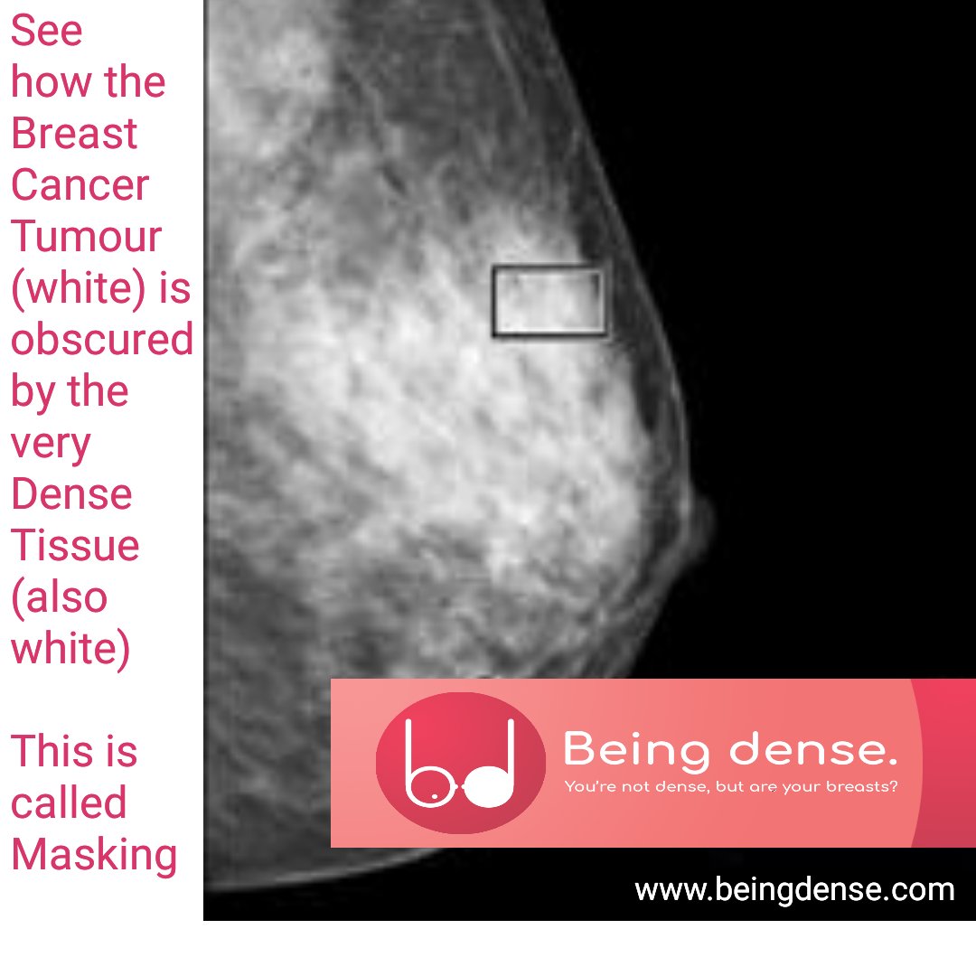 Breast Density can mask Breast Cancer and often does which is why  http://Beingdense.com  advocates all women be informed of their personal Mammographic Breast Density as determined by their Screening Mammogram  #bccww  #bcsm  @BreastCancerIre  @med_indonews