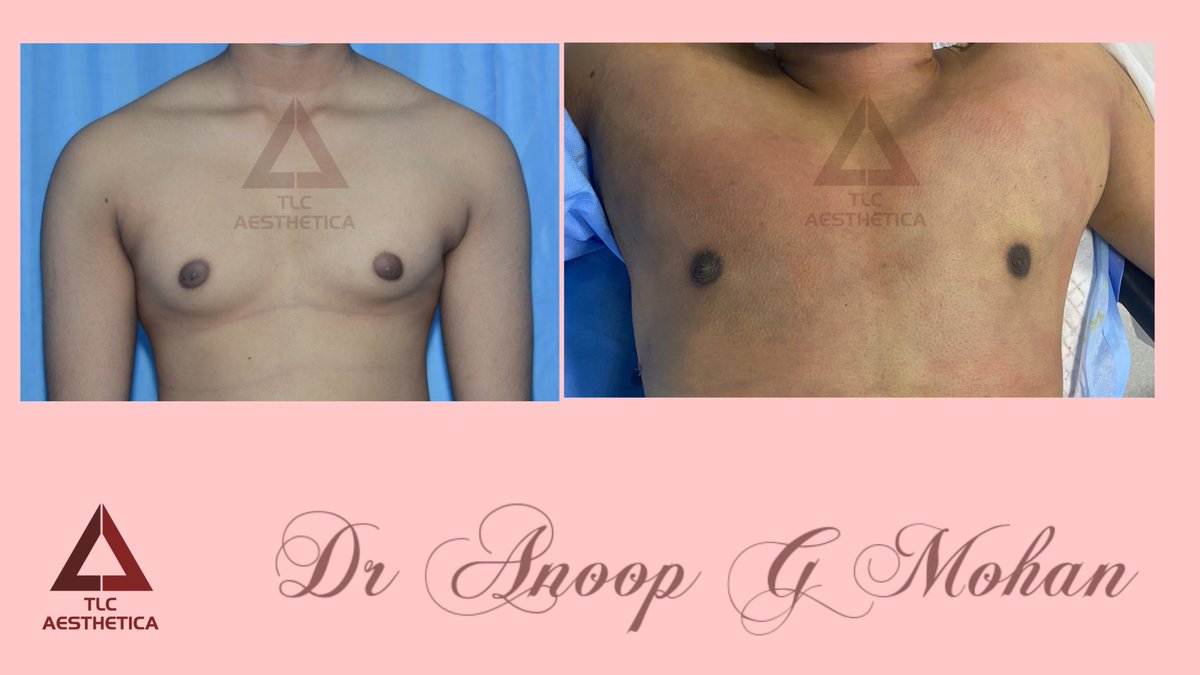 TlcAesthetica's tweet photo. The perfect solution for #Manboobs #Gynecomastia
 #TriLipo #VaserLipo
@anoopgmohan 💓 https://t.co/1mNHLk61IH