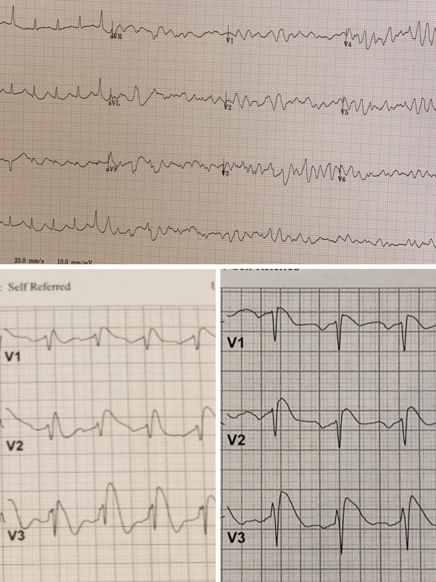 50 y/o AAM w/ HTN, colon cancer s/p resection, on chemo, presented w/ VF arrest received multiple external shocks before Isuprel and Quinidine administered. #EPeeps #brugada #brugadasyndrome @KennethEllenbo1