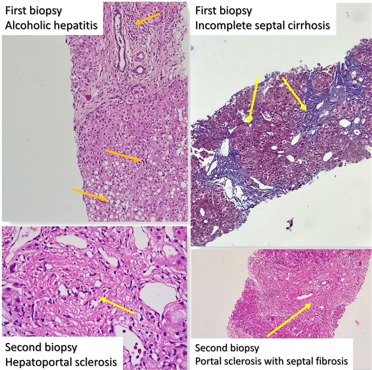  #liver  #biopsy Diagnosis: severe  #alcohol  #hepatitis and underlying  #incomplete septal  #cirrhosis (rare,  #hepatoportal sclerosis) - 2 diseases in one liver!  #radiology WHY DID THIS HAPPEN?See retrieved  #Ayurveda  #drugs analysis results. #pseudocience 2/4