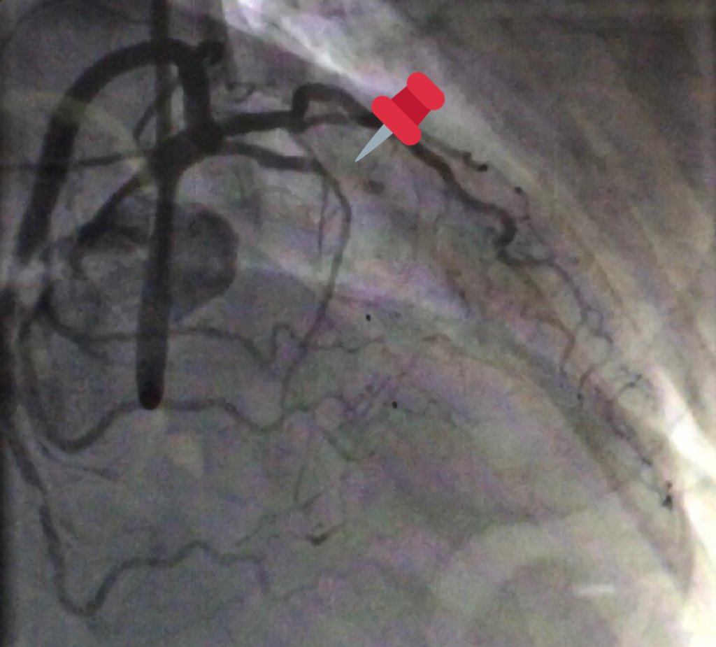 mirvatalasnag's tweet photo. #ACCIC #EAPCI @APSIC6 
It’s not over till it’s over
#STEMI Pre &amp; post
✅Branches &amp; blush
✅ACT
✅Access
‼️Rhythm https://t.co/oPeerbOJRB