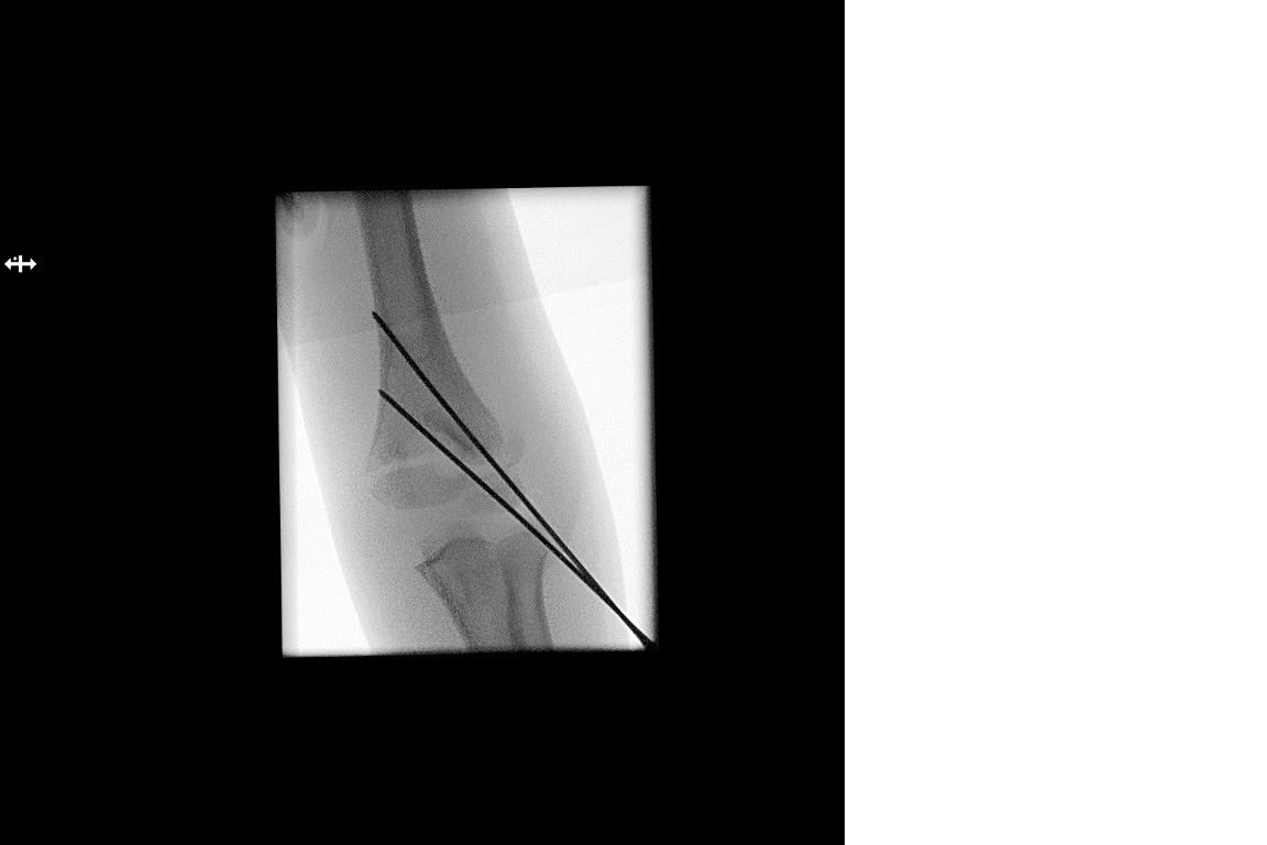 sayanamk's tweet image. A little, flexible K-wire can do the trick! #Kapandji
#BasicPhysics #LeverArm
#PerCutaneousReduction
#SupraCondylarFracture
#MedTwitter #orthotwitter #OrthoTweetorial #SundayThoughts