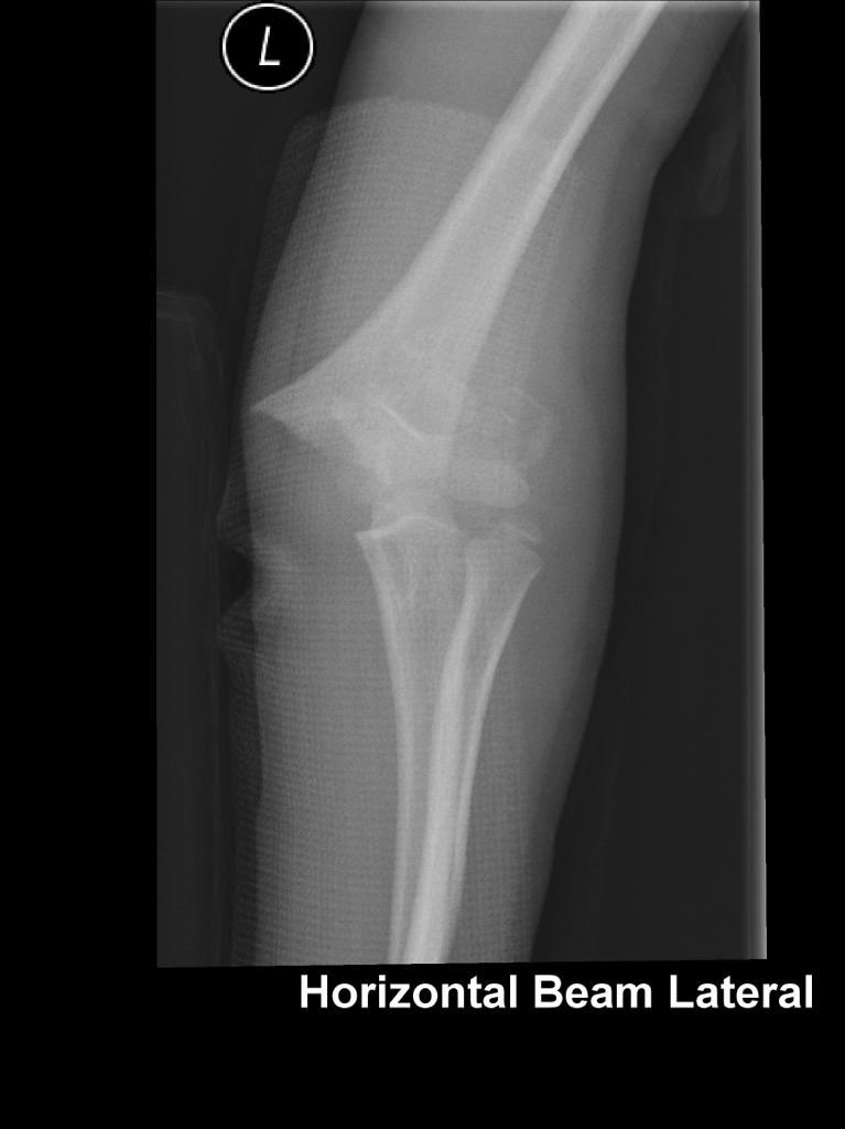 sayanamk's tweet image. A little, flexible K-wire can do the trick! #Kapandji
#BasicPhysics #LeverArm
#PerCutaneousReduction
#SupraCondylarFracture
#MedTwitter #orthotwitter #OrthoTweetorial #SundayThoughts