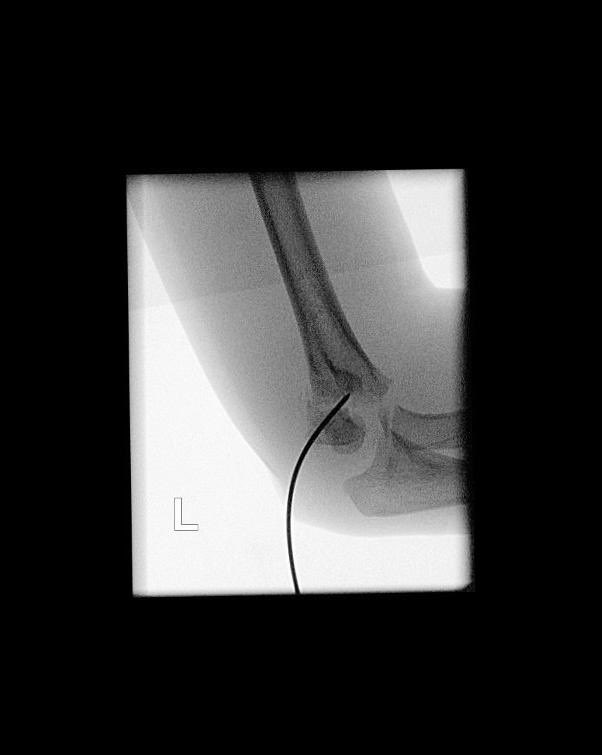 sayanamk's tweet image. A little, flexible K-wire can do the trick! #Kapandji
#BasicPhysics #LeverArm
#PerCutaneousReduction
#SupraCondylarFracture
#MedTwitter #orthotwitter #OrthoTweetorial #SundayThoughts