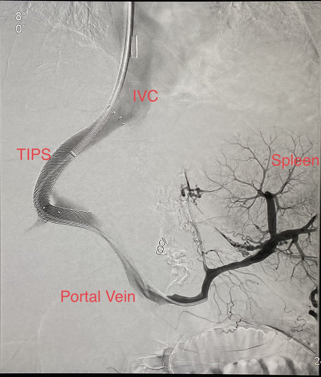 DrKaloo's tweet photo. TIPS stops upper Gastrointestinal bleeding instantaneously

38 male, cirrhosis with profuse hematemesis. Bleeding continued after EVL. Shock

1. Venography: bunch of gasto-esophageal varices (arrow)

2. TIPS stent placed

3. Varices embolised

4. Final venogram

#iRad #TIPS https://t.co/7T8cZoTVE4