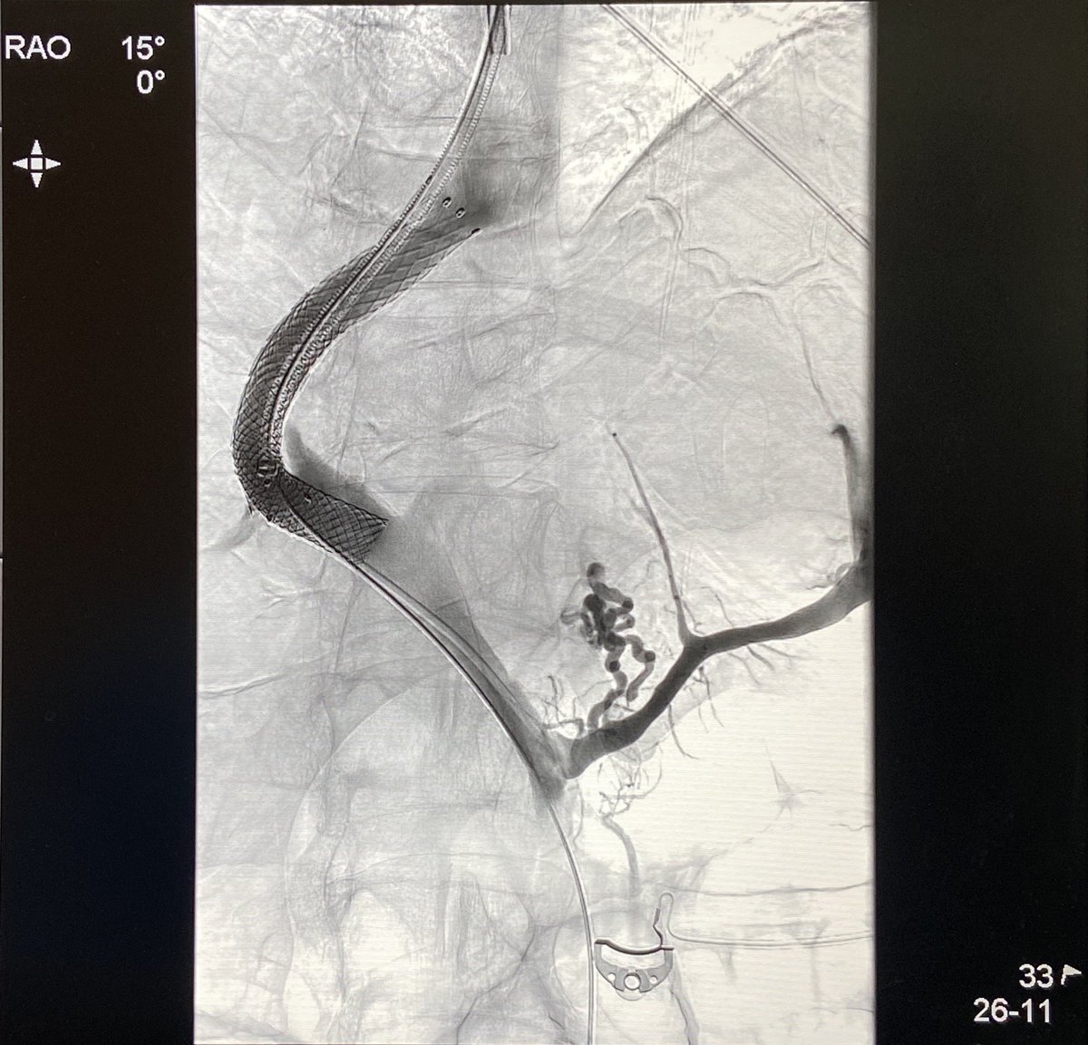 DrKaloo's tweet photo. TIPS stops upper Gastrointestinal bleeding instantaneously

38 male, cirrhosis with profuse hematemesis. Bleeding continued after EVL. Shock

1. Venography: bunch of gasto-esophageal varices (arrow)

2. TIPS stent placed

3. Varices embolised

4. Final venogram

#iRad #TIPS https://t.co/7T8cZoTVE4