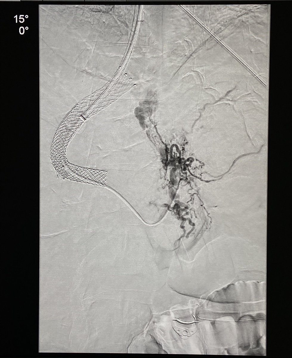 DrKaloo's tweet photo. TIPS stops upper Gastrointestinal bleeding instantaneously

38 male, cirrhosis with profuse hematemesis. Bleeding continued after EVL. Shock

1. Venography: bunch of gasto-esophageal varices (arrow)

2. TIPS stent placed

3. Varices embolised

4. Final venogram

#iRad #TIPS https://t.co/7T8cZoTVE4