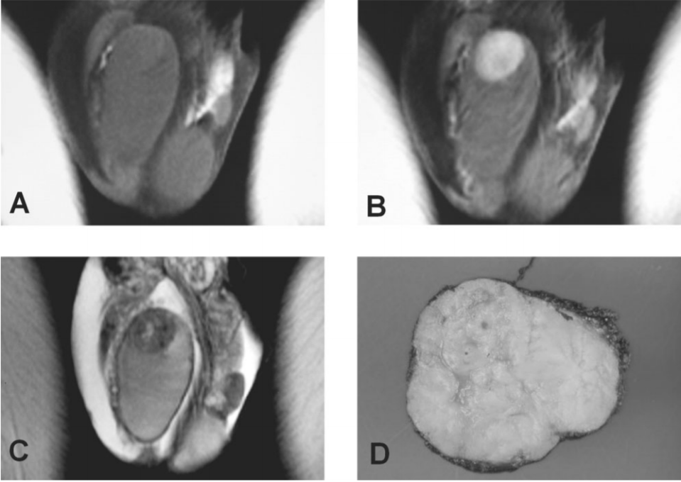 The MRI findings of Leydig cell tumour:
Enhancement on post-contrast T1 weighted images, 
low signal intensity signal on T2 weighted images with high
signal intensity foci secondary to central scar.
birpublications.org/doi/abs/10.125…
