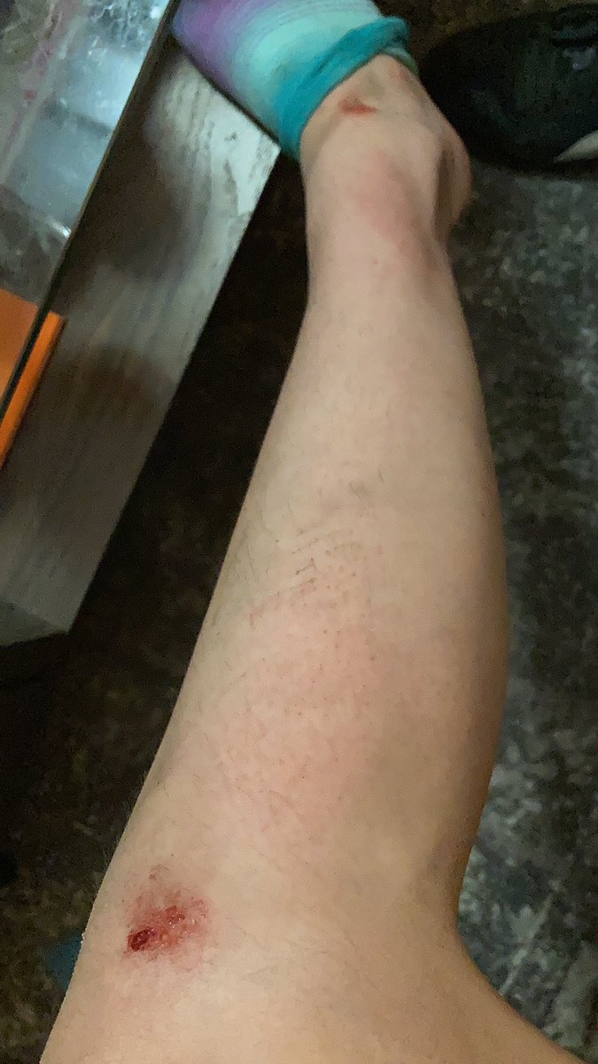 Road rash from a dumptruck of a cop shoving me so hard I lost my phone and nearly brained myself on the steel bridge railing