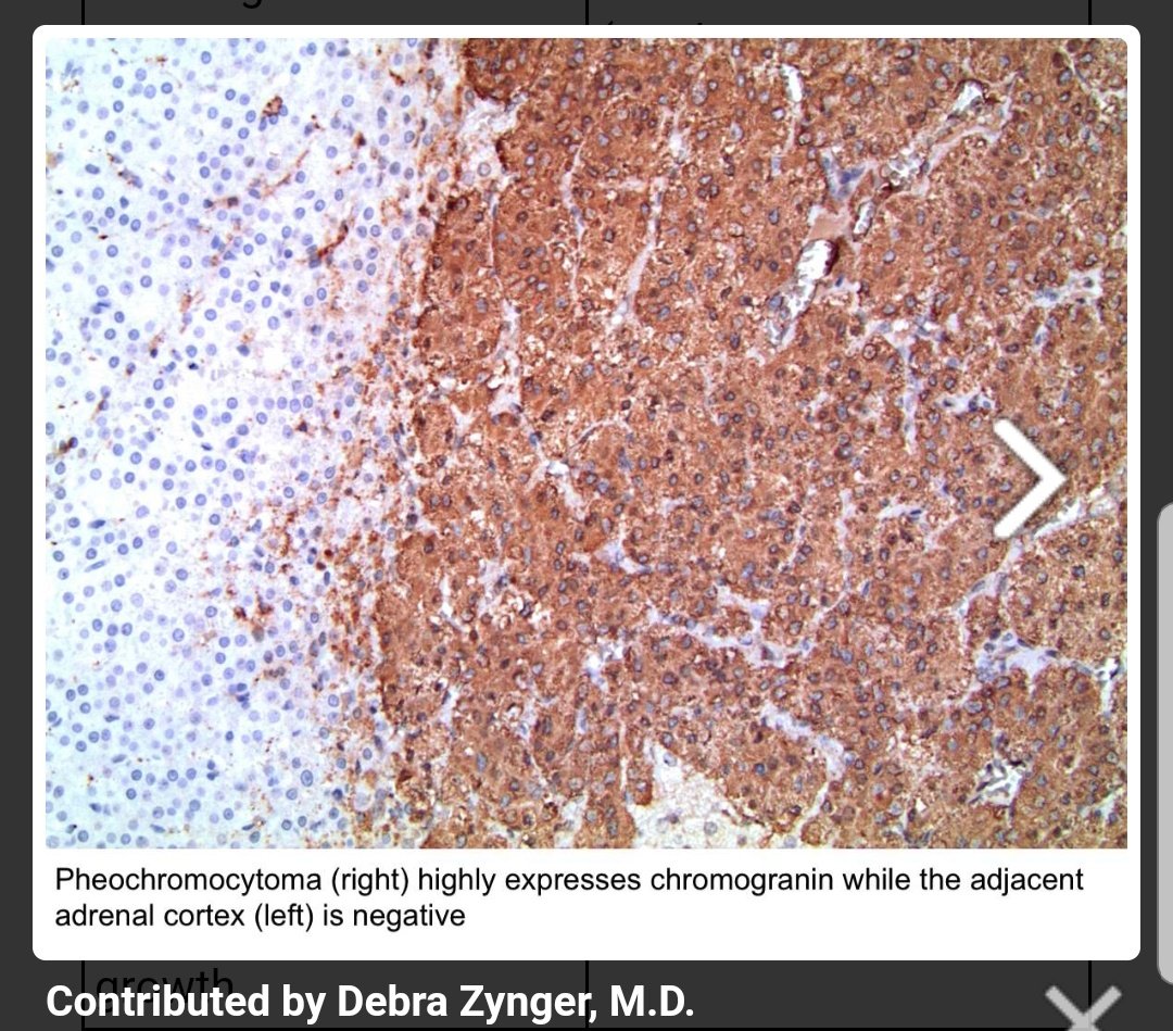 Also never forget that the best IHCs are a good history and a skilled morphologist Keratin negativity is your major clue for a pheo/paraG origin. To support this, there should be CgA and Syn positivity. Other markers to support the diagnosis is GATA-3 and loss of SDHB.