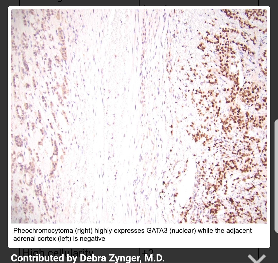 Also never forget that the best IHCs are a good history and a skilled morphologist Keratin negativity is your major clue for a pheo/paraG origin. To support this, there should be CgA and Syn positivity. Other markers to support the diagnosis is GATA-3 and loss of SDHB.