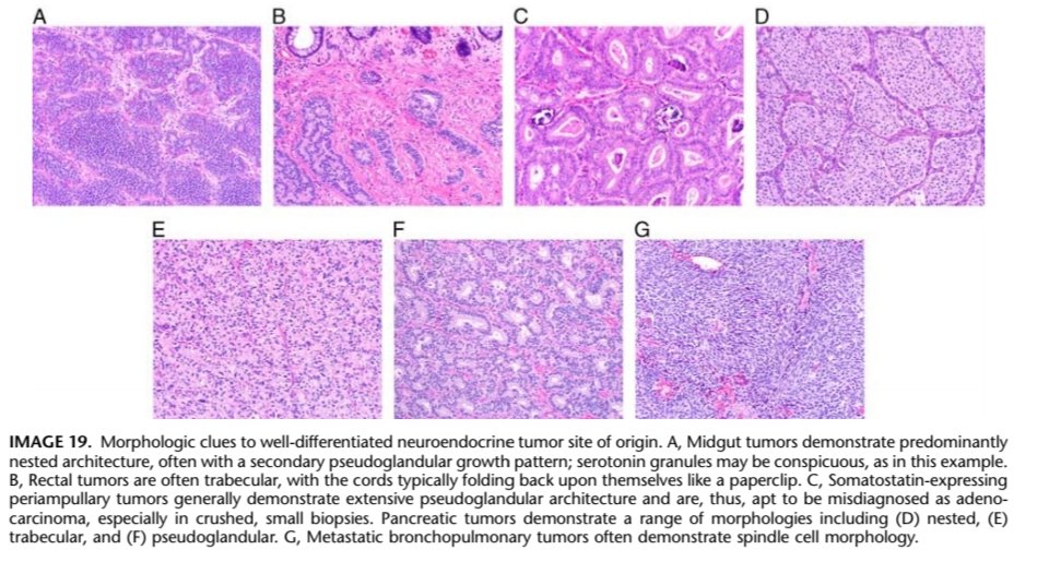 For Well Diff. NE tumors (WDNETs) Determining the primary origin of the tumor would be important in management and prognosis. Morphology and architectural pattern play a role in dx:Nested- midgutTrabecular- rectalPseudoglandular- periampullarySpindly- bronchopulmonary