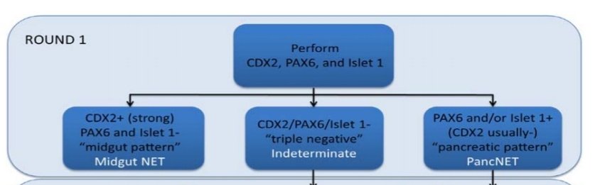 In the first round of IHCs, effort is made to rule these two out- wherein a strong CDX2 staining with negative PAX6 or Islet1 points toward a Midgut NETWhile positive PAX6 and/or Islet1 will point towards a PancNET.Negative staining for these 3 would push towards Round 2.