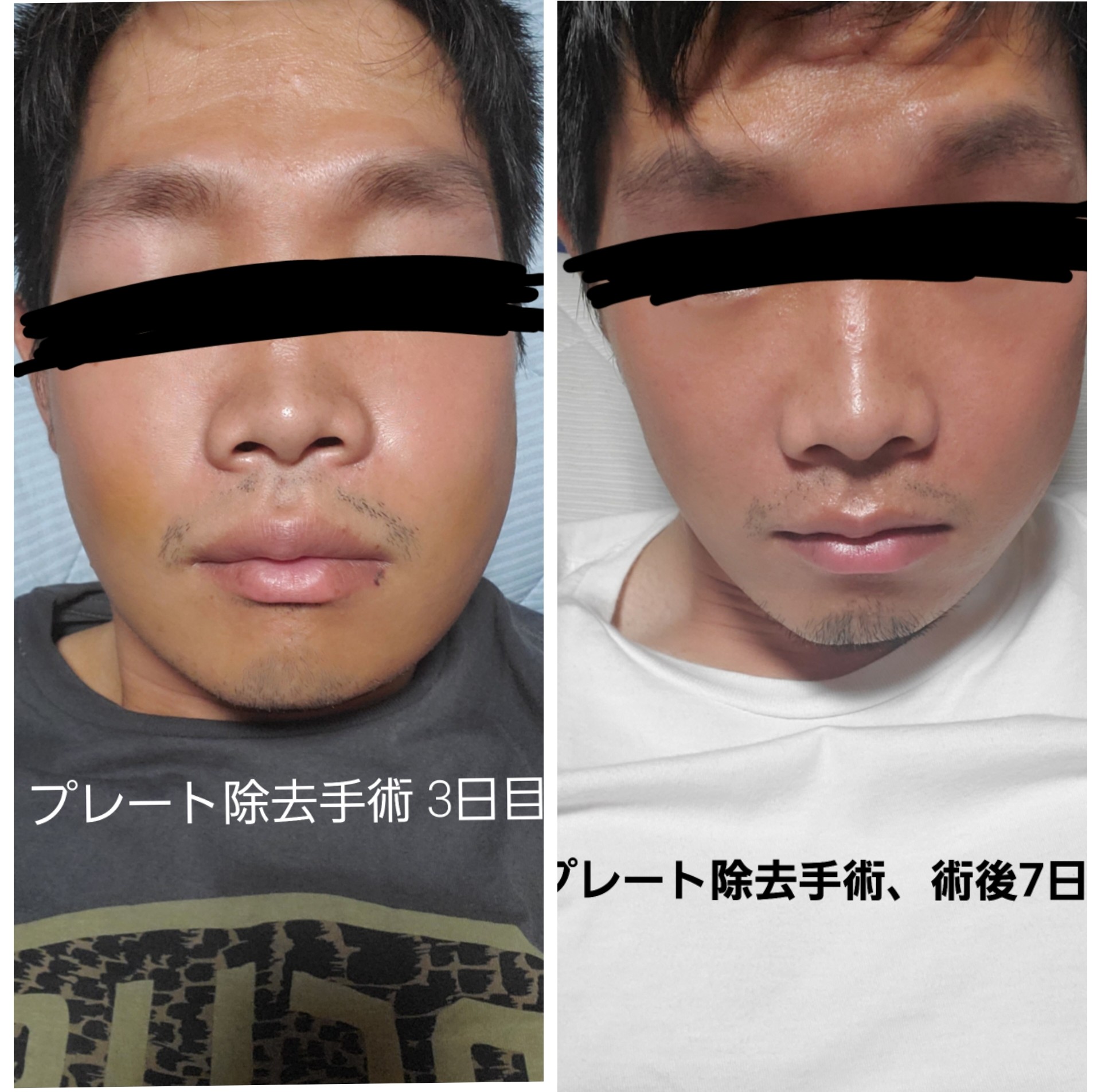 プレート除去手術 Twitter Search Twitter