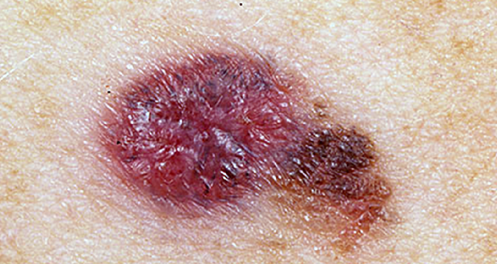 WebMD's tweet image. Skin cancers -- including melanoma -- often start as changes to your skin. Learn to spot the early warning signs: wb.md/32RKGNW