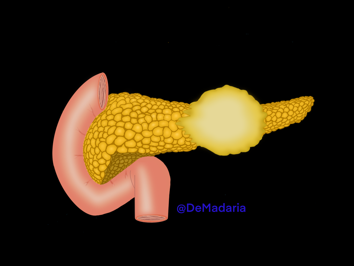 Pancreatic ductal adenocarcinoma (PDAC) is a very aggressive tumor, a perfect enemy that grows quietly, expands quickly and is resistant to chemo and radiotherapy.